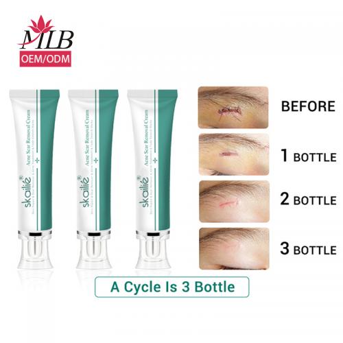 Crema para eliminar cicatrices de acné